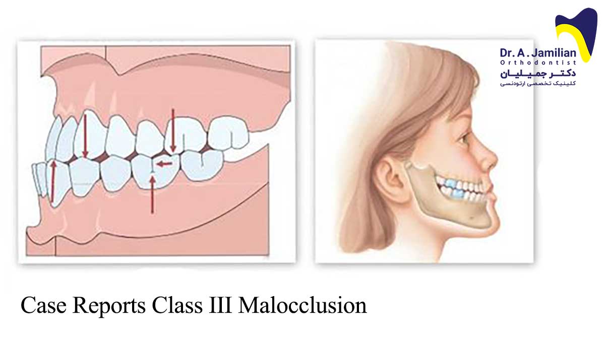 class 3 malocclusion