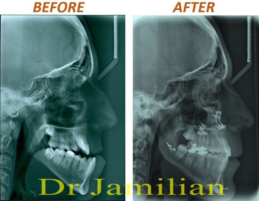 Dr Jamilian Orthodontic Clinic Case Reports Class Iii Malocclusion Dr Jamilian Orthodontic Clinic Case Reports Class Iii Malocclusion