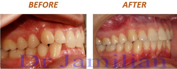 bite deep case report overbite angle retention upper orthodontic dr