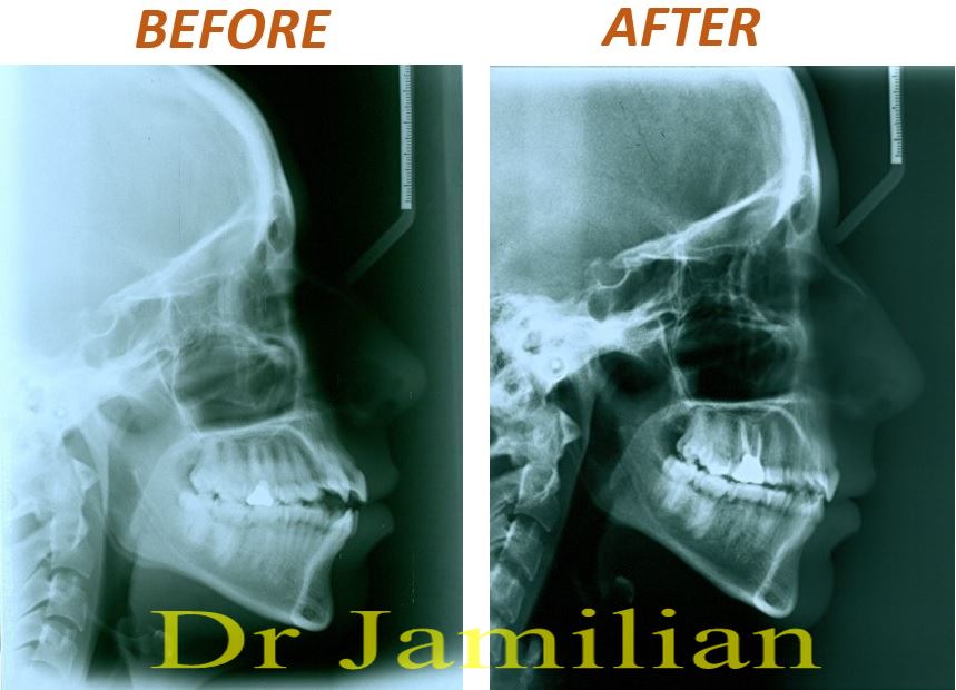 Radiography of the patient's skull with open bite malocclusion