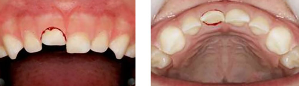 صورة لصدمة الأسنان اللبنية