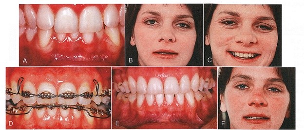 اوربایت عمیق در خانمی 3 ساله قبل (A-C) ، حین (D)، و بعد از (E و F) درمان ارتودنسی. نمایش اولیه ی دندانهای ثنایای ماگزیلا در حالت استراحت (B) مشابه یک بیمار بسیار مسن تر است. به همین دلیل، ثنایای سانترال ماگزیلا با خم های step-down در آرچ وایر، اکسترود شده، و دندانهای ثنایای مندیبل با استفاده از یک overlay base arch اینترود شدند (D). نتایج نهایی نشان دهنده ی تصحیح اوربایت (E) بوده و میزان نمایش ثنایای ماگزیلا هم به سن بیمار نزدیکتر شده است (F).