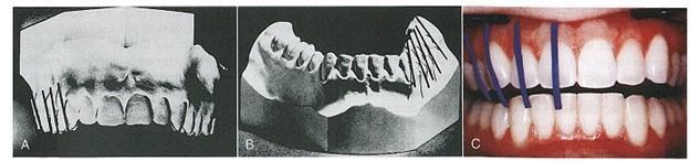 تمایل محوری لینگوالی مطلوب در تاج دندانهای خلفی بالا و پایین
