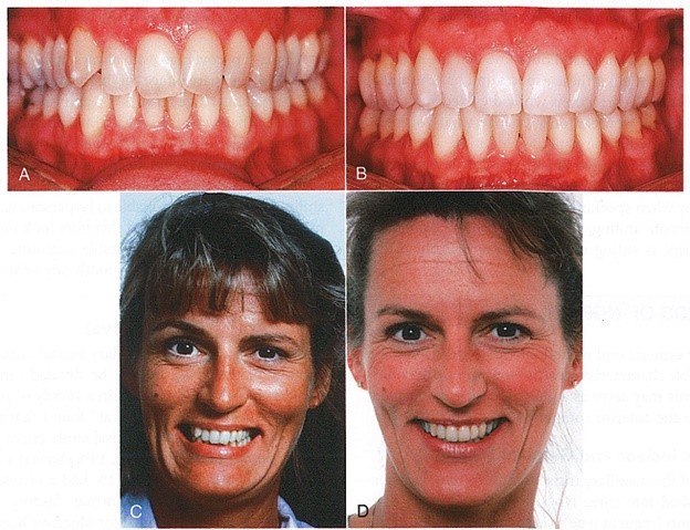 A-D، بهبود در توازی بین انحنای دندانهای قدامی ماگزیلا و کانتور لب پایین با درمان ارتودنسی در خانم بالغی با کروادینگ هر دو فک. Cant میدلاین ثنایای سانترال نیز اصلاح شده است.