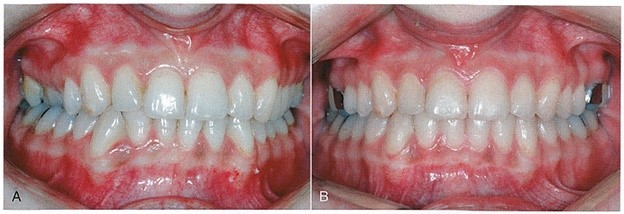دندانهای خلفی پایین rolled-in (مخصوصاً سمت راست) و کراس بایت محدود