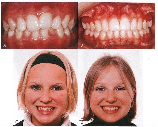 کراودینگ مختصر هر دو فک بدون کشیدن دندان