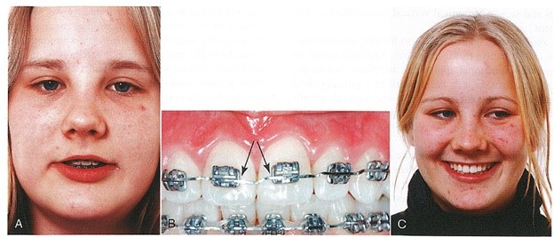 هرگاه با صاف شدن قوس لبخند حین درمان مواجه شدید (A)، می توانید دندانهای ثنایای سانترال را با خم های step-down (فلش های تصویر B) اکسترود نمایید تا قوس و توازی آن با کانتور داخلی لب را بهبود ببخشید (C).