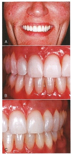 دندانهای انتهایی قابل مشاهده در لبخند، مولرهای اول ماگزیلا