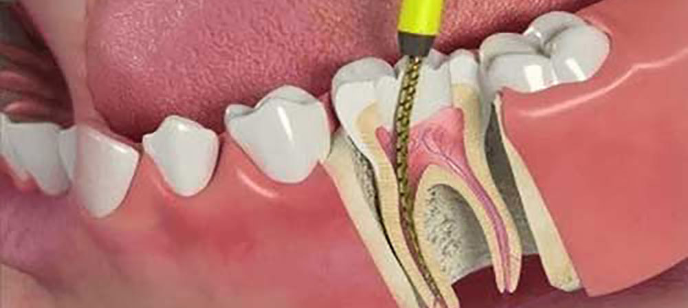 a mandibular and a tooth under root canal treatment