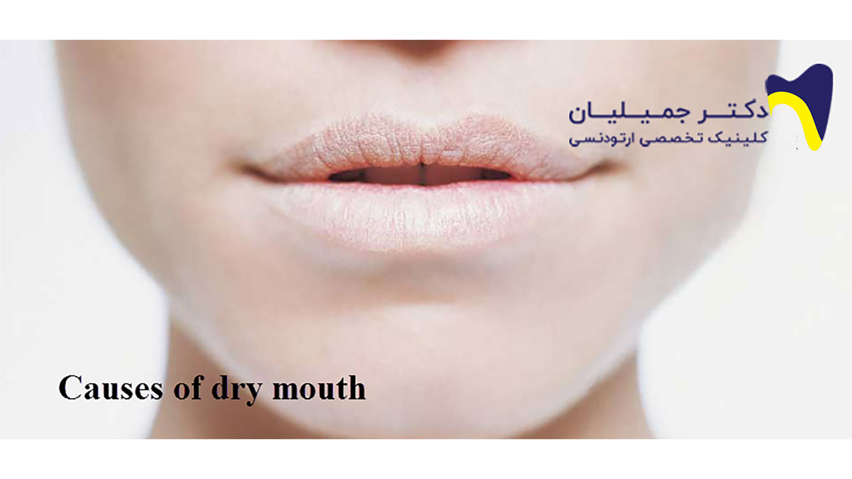 علت خشکی دهان