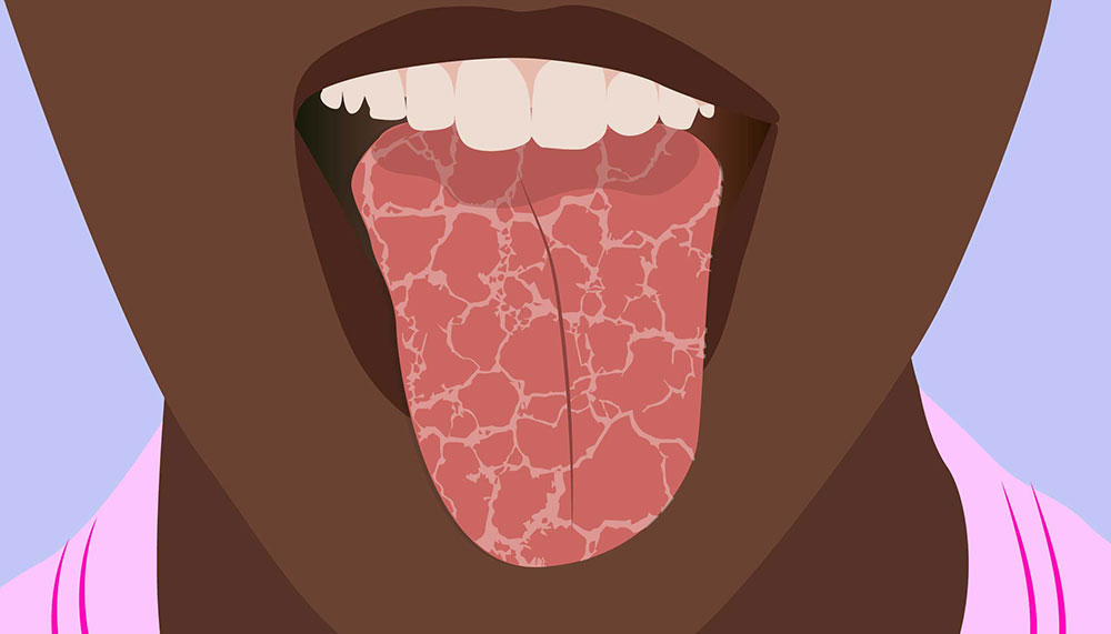 خشکی دهان بر اثر شرایط فیزیکی بیمار