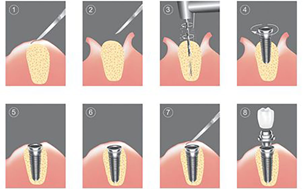 how to place dental implant