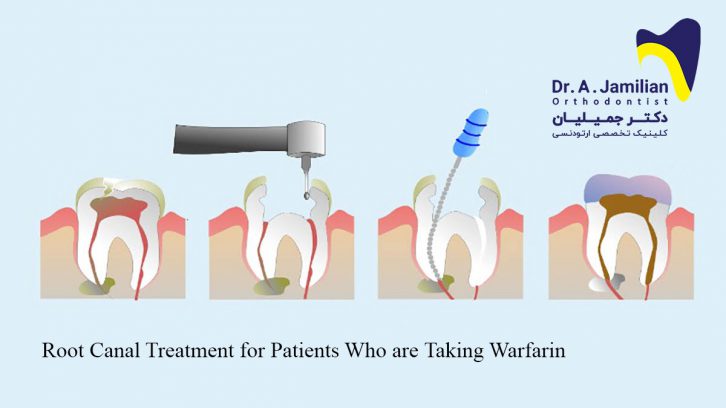 Root Canal Treatment For Patients Who Are Taking Warfarin Dr Jamilian 