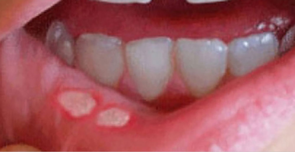 Mundhöhlenkrebs bilder 🏥 Wie
