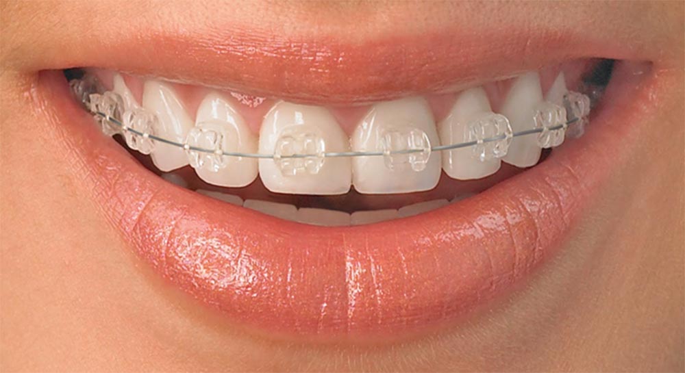 ceramic fixed orthodontics