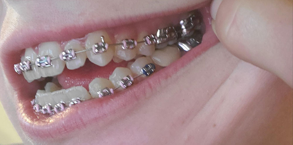 fixed orthodontics banding