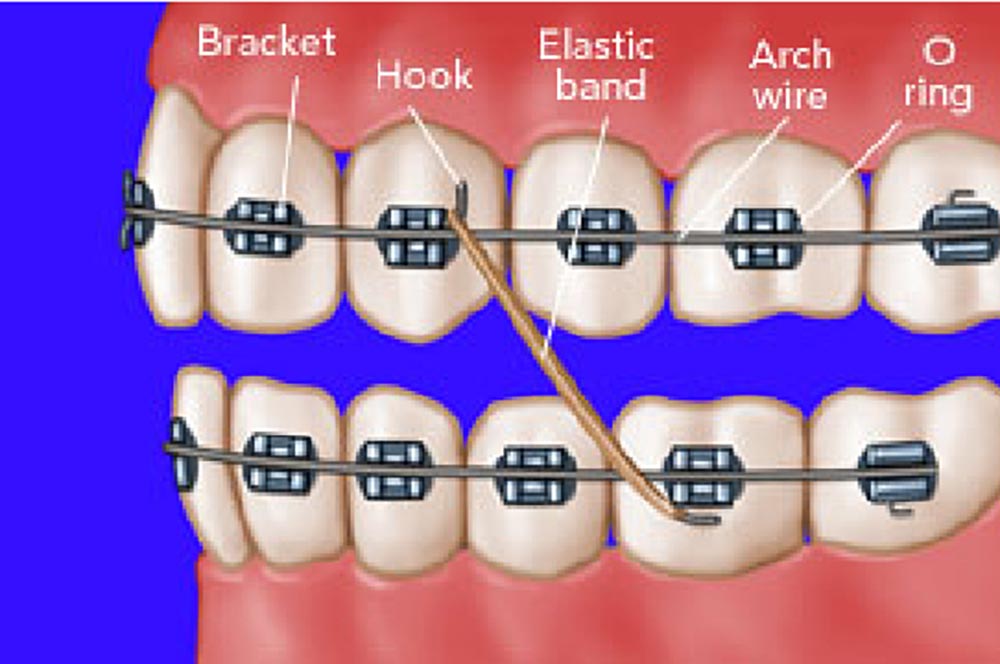 fixed orthodontics with its components