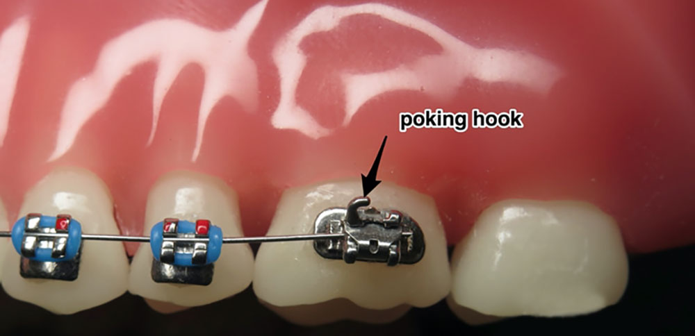 poking hook of fixed orthodontics