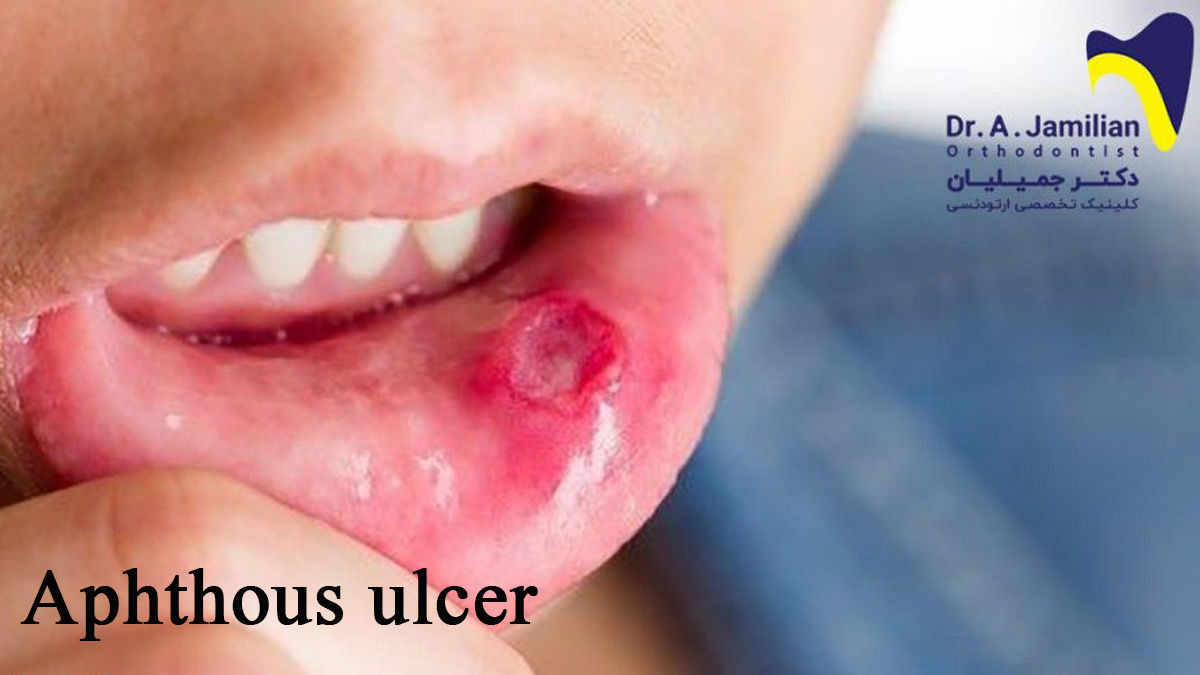 aphthous-ulcer-and-its-treatment-dr-jamilian