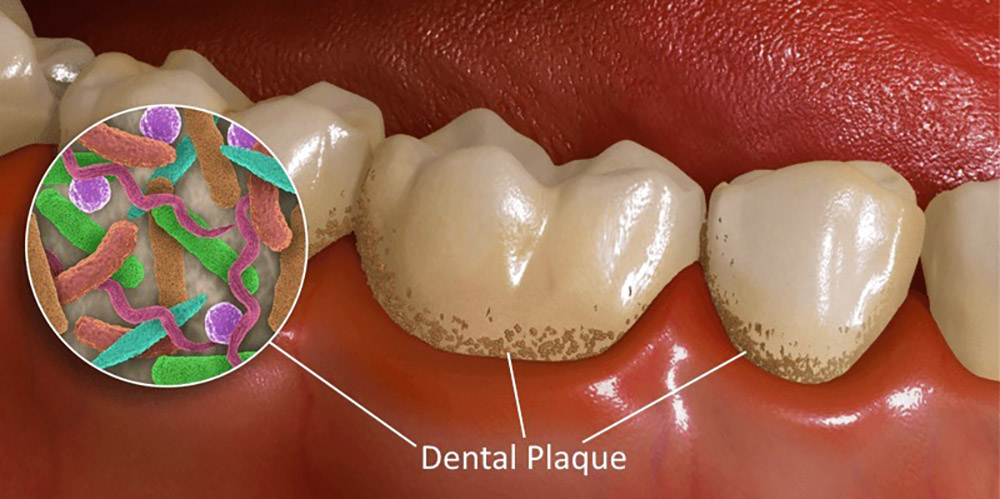 bakterienplaque auf den zähnen