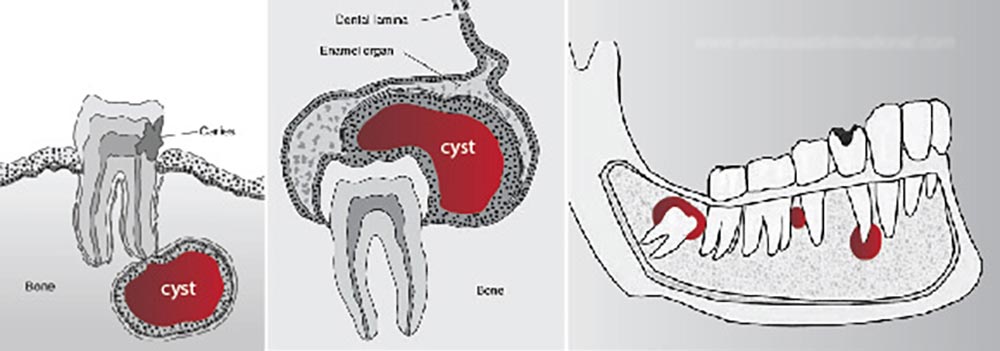 يتم عرض أنواع أكياس الأسنان بشكل تخطيطي في عظم الفك
