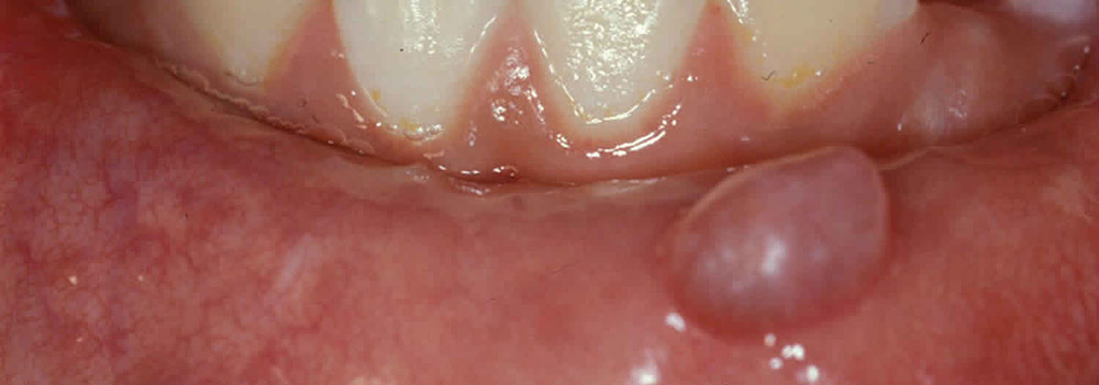 Zahnschleimhautzyste
