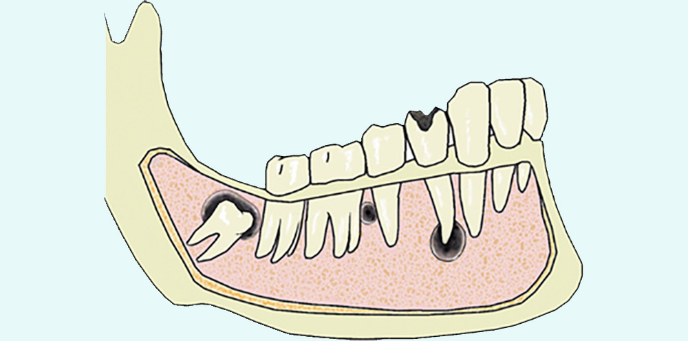 کیست دندان ادونتوژنیک