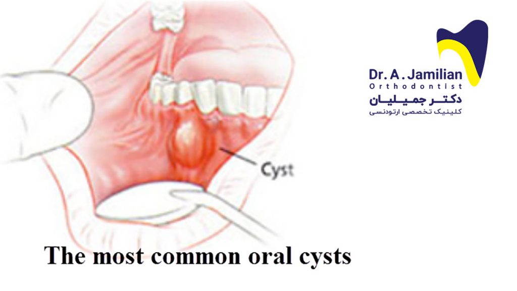The most common oral cysts Dr Jamilian