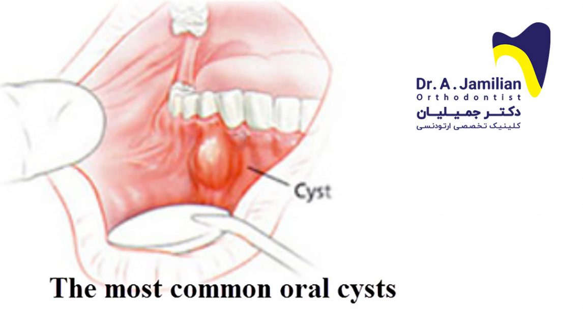 The Most Common Oral Cysts Dr Jamilian 0956