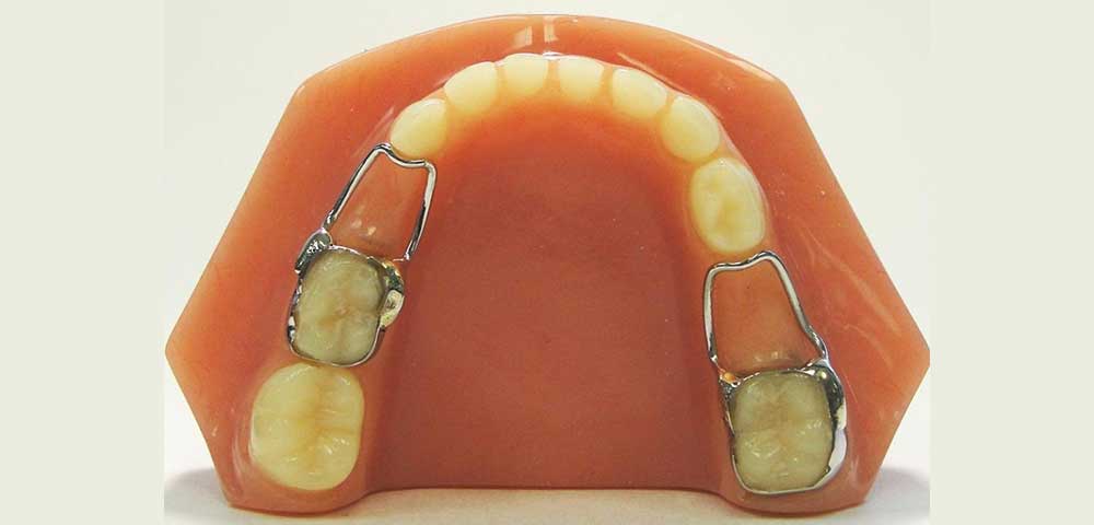 دو فضانگهدار ثابت دندانی