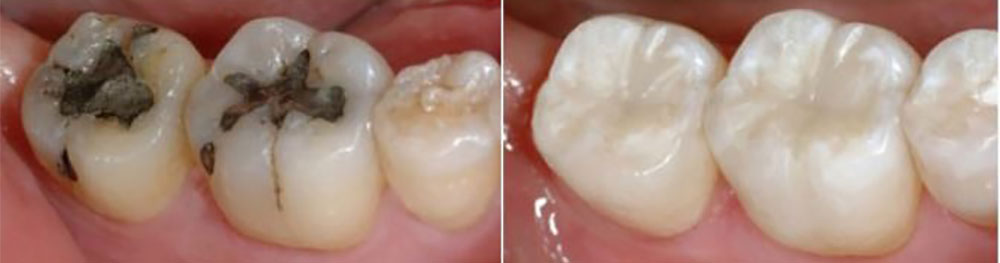 جایگزینی پرکردگی دندان