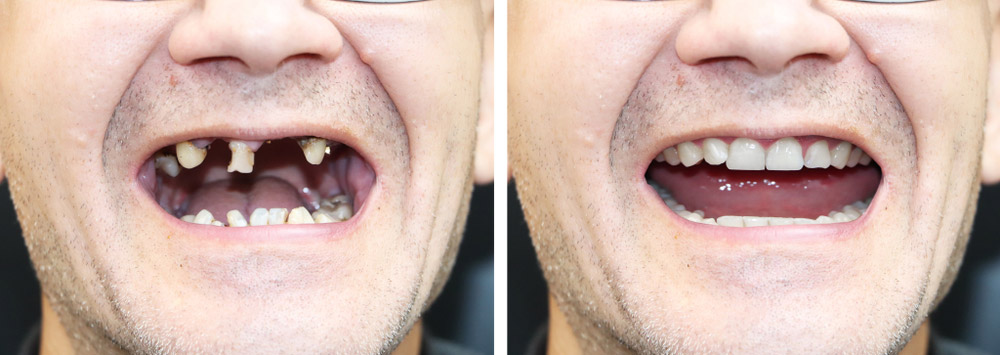 image before and after using dentures
