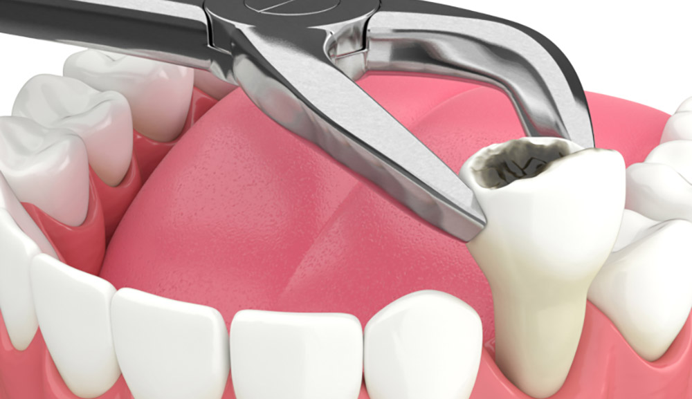 کشیدن دندان و دندانی که در حال خارج شدن از دهان است