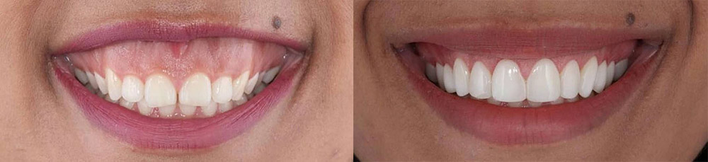 vor und nach der behandlung zur korrektur des zahnfleischlächelns