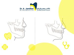 قبل و بعد از جراحی جلو آوردن فک بالا