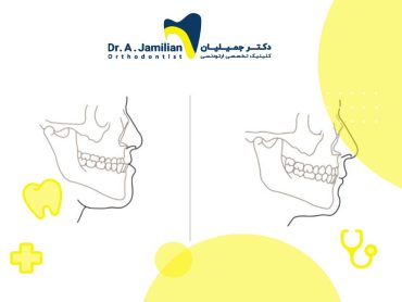 قبل و بعد از جراحی جلو آوردن فک بالا