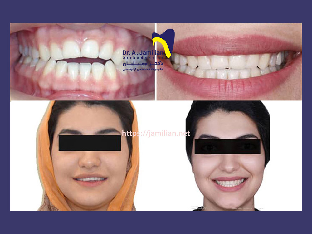 before and after smile design correction