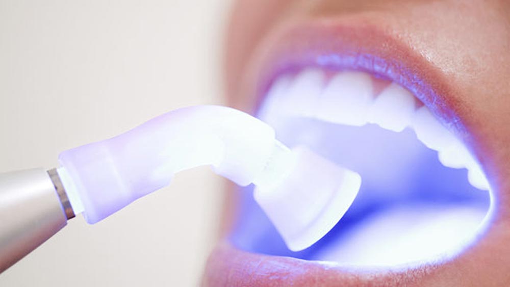 laser treatment of teeth