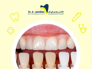 dental veneer in front of real human teeth