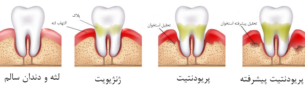 مراحل بیماری لثه در اثر نصب نادرست لمینت های دندانی