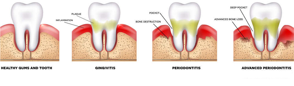 stages of gum disease due to improper installation of dental veneers