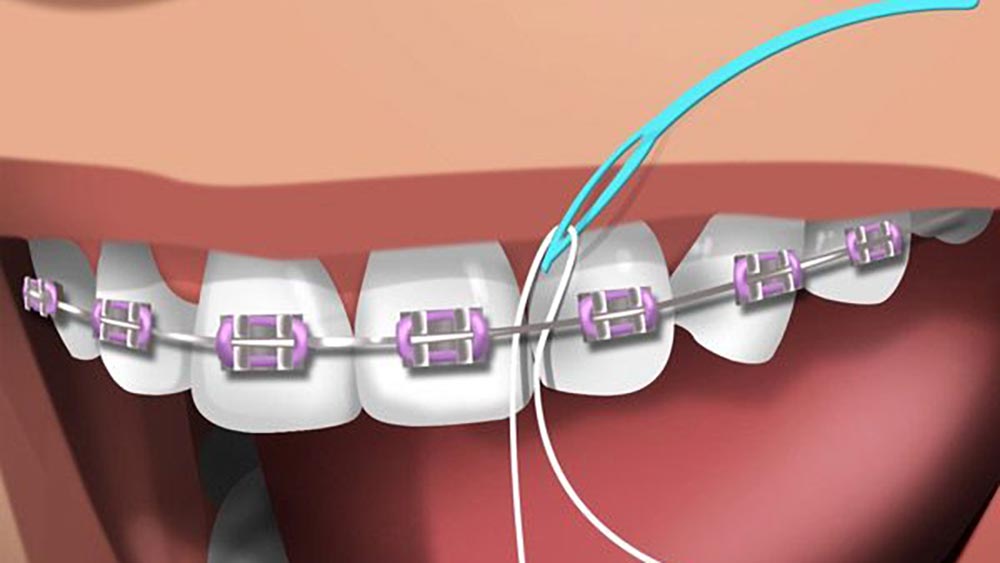 dental floss and orthodontics