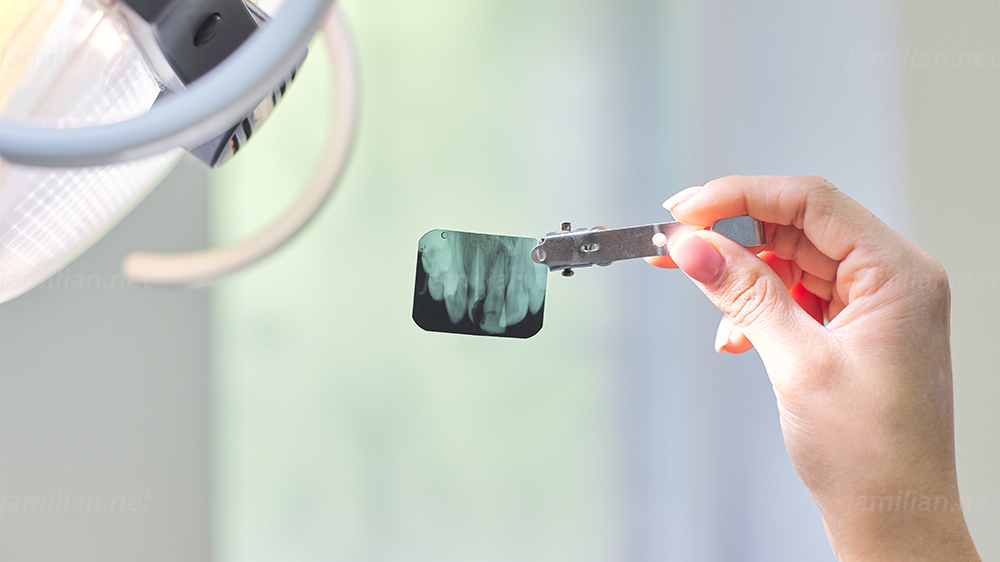 عکس دندان در دست با اشعه ایکس از نمای نزدیک