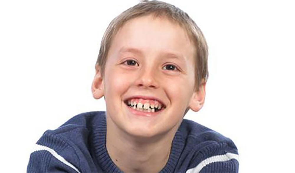 Abnormales Aussehen aufgrund von Kiefer- und Zahnanomalien