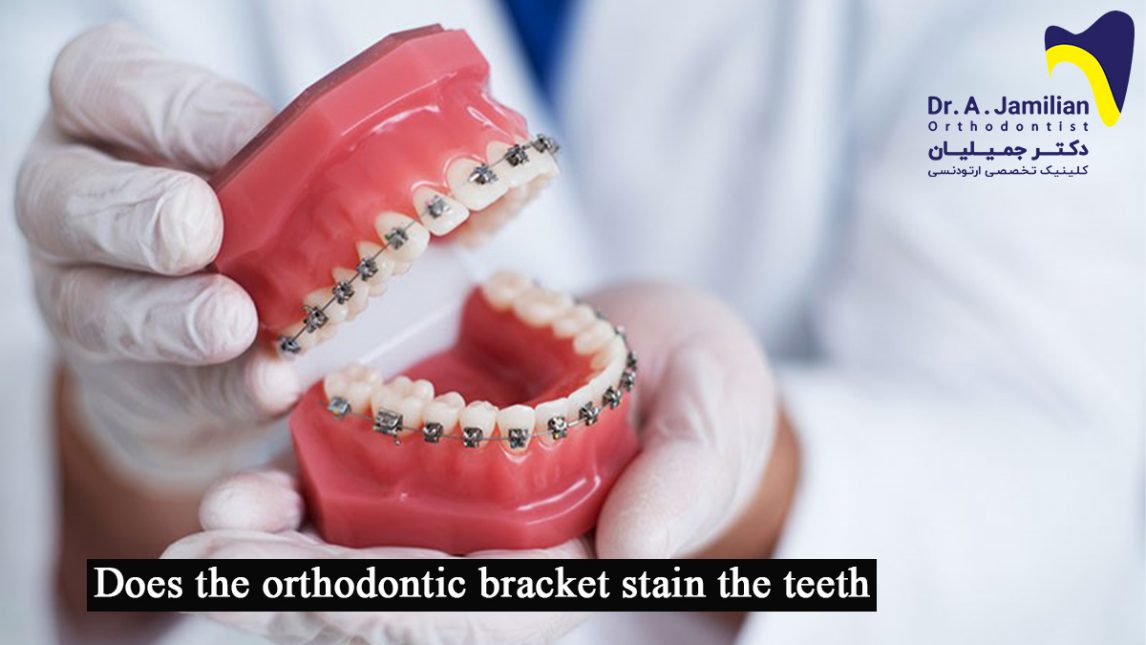 Does the orthodontic bracket stain the teeth? Dr Jamilian