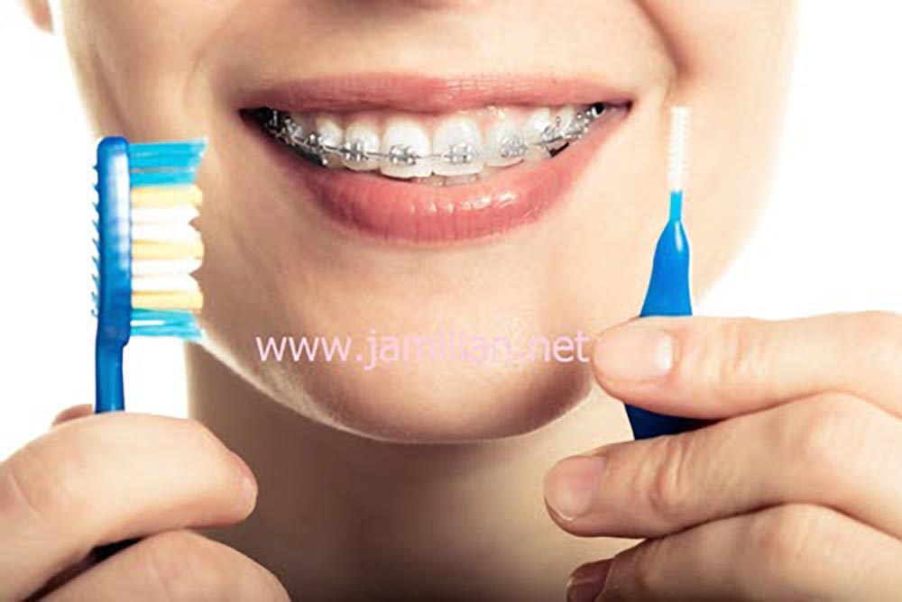 خانمی با دندان های ارتودنسی و در دست داشتن مسواک ارتودنسی بین دندانی و مسواک معمولی