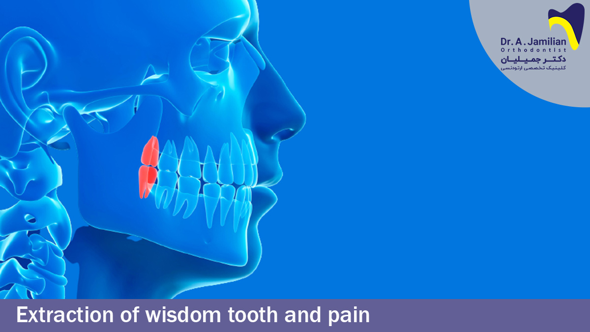 Extraction Of Wisdom Tooth And Pain Dr Jamilian
