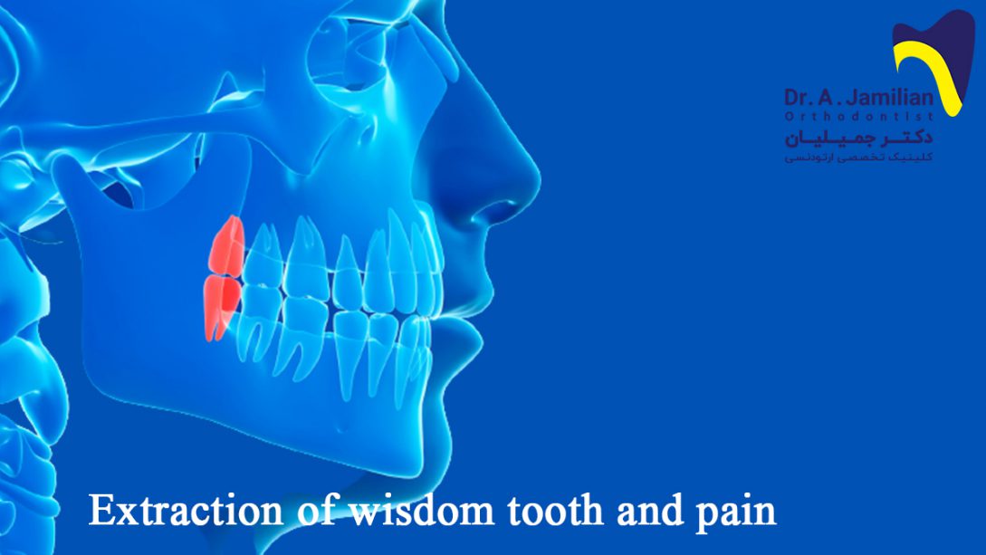 Extraction of wisdom tooth and pain Dr Jamilian