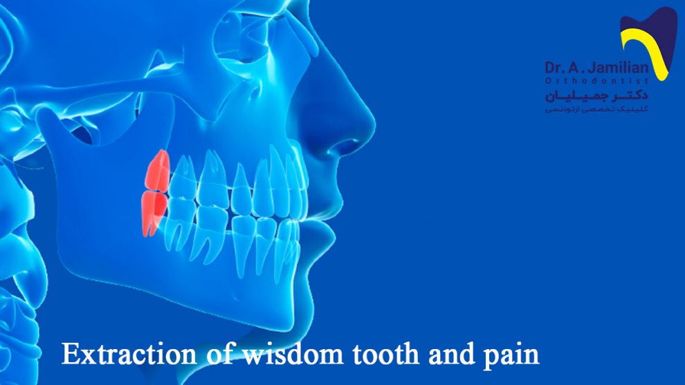 Extraction of wisdom tooth and pain Dr Jamilian