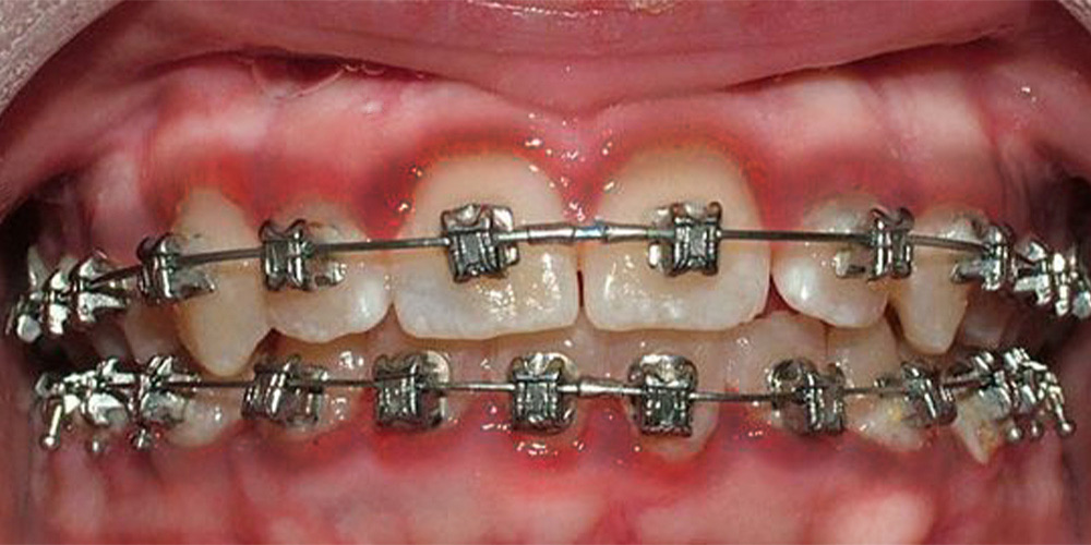 a person with orthodontics having gum infection
